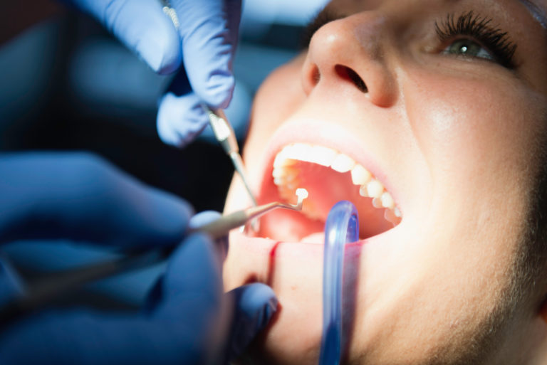 Inlay, Onlay Dentiste à prix abordables Clinique Dentaire Implantcenter